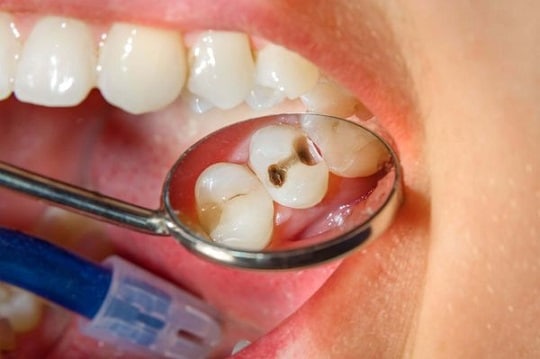  Заболявания на устната празнина и зъбите 